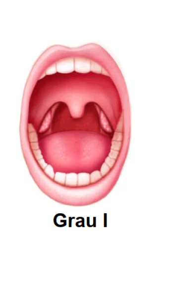 Amígdala Grado I