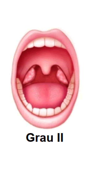 Amígdala Grado II