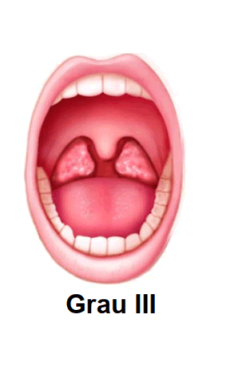 Amígdala Grado III
