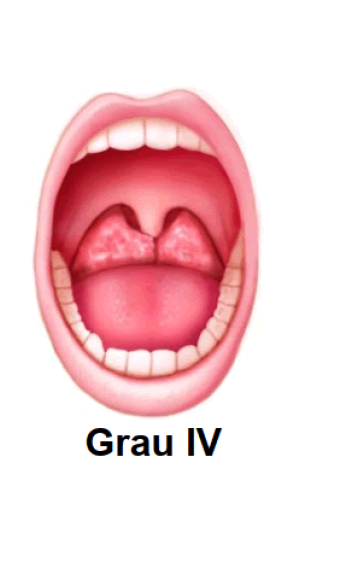 Amígdala Grado IV
